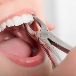 How-Are-Simple-and-Surgical-Tooth-Extractions-Different