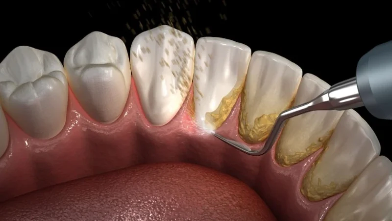 Teeth-scaling-and-root-planing