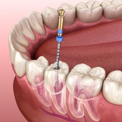 Endodontic root canal treatment process. Medically accurate tooth 3D illustration.